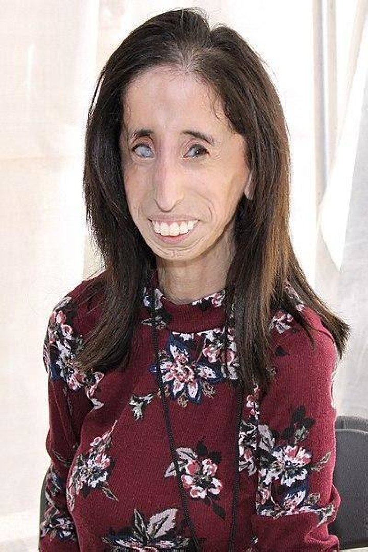 
Lizzie Velasquez Illness: What Disease Does Lizzie Velasquez Have? 