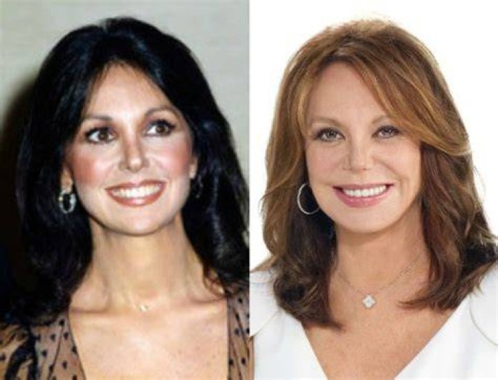 Marlo Thomas Plastic Surgery: What Happened To Her Face?