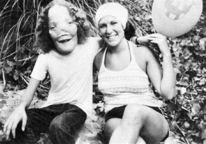 Rocky Dennis Cause of Death, How did Rocky Dennis Die?